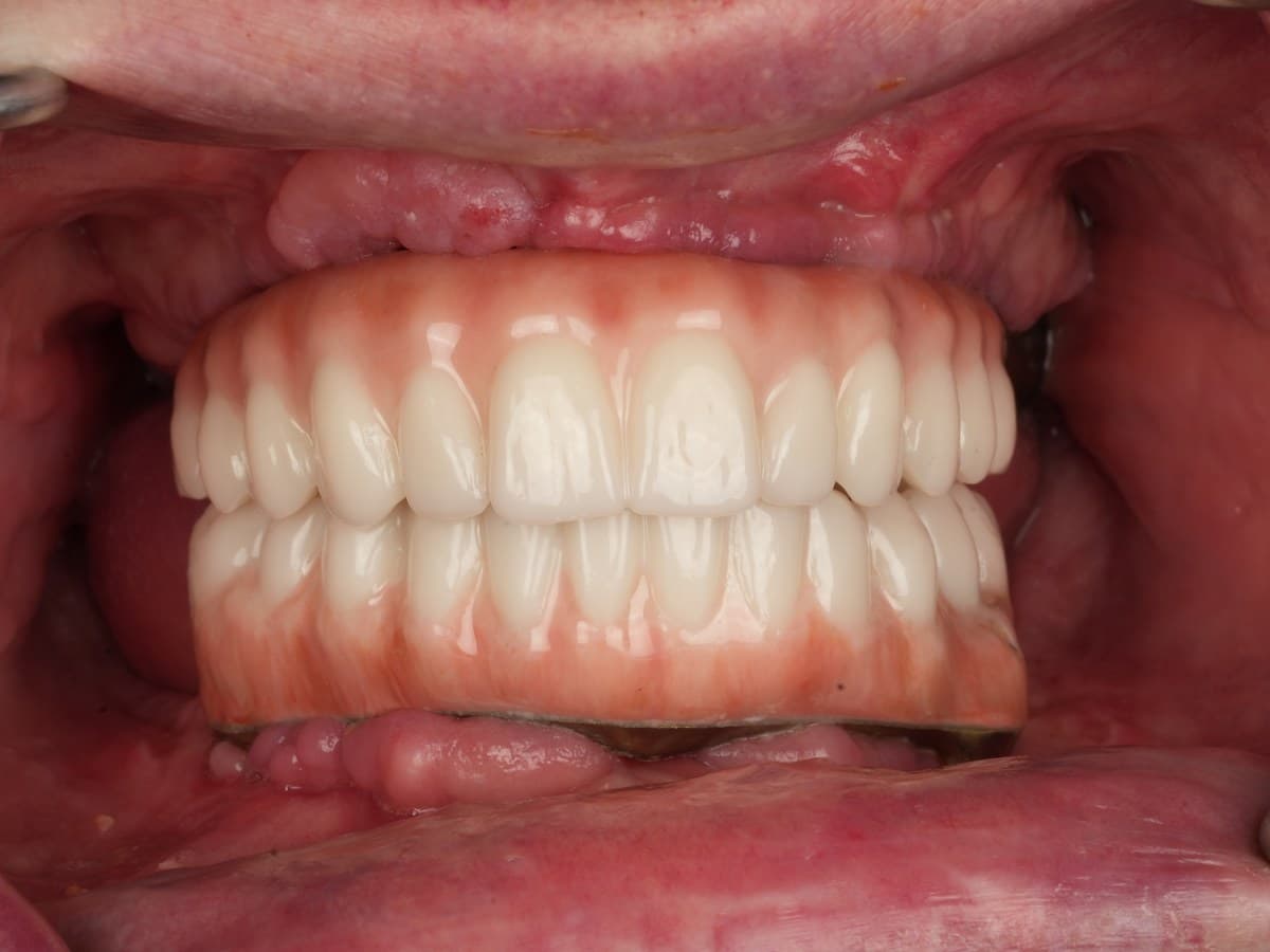 After treatment