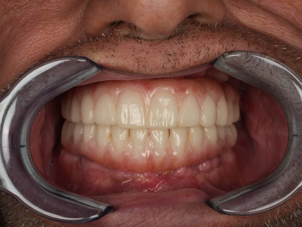 After treatment
