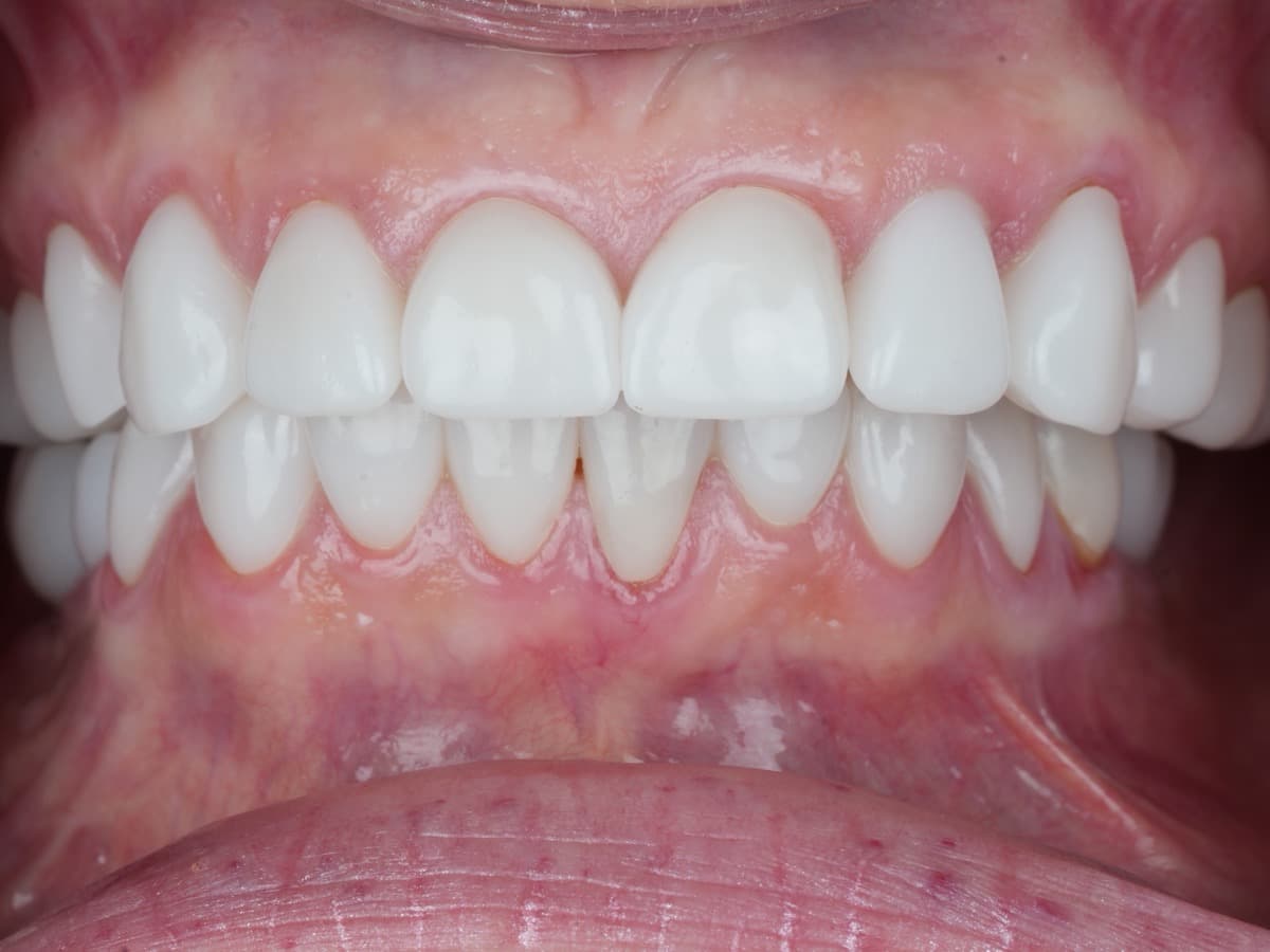After treatment