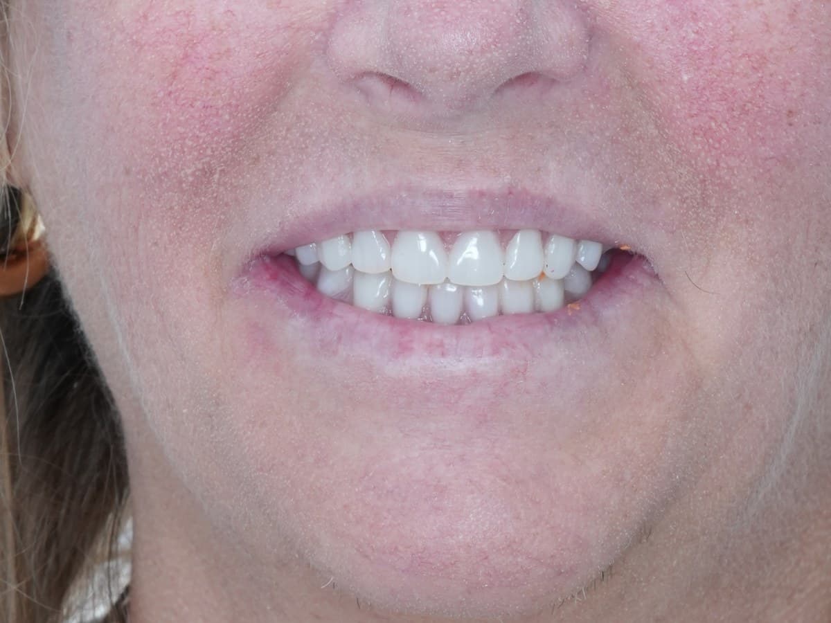 After treatment