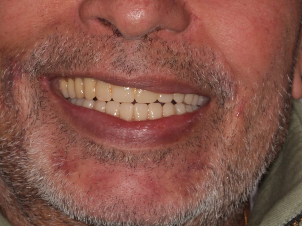 After treatment